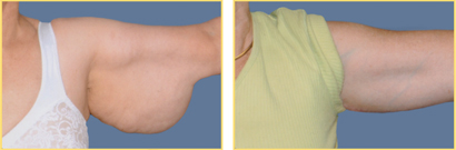 Before and After Brachioplasty