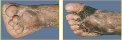 Foot Reconstruction