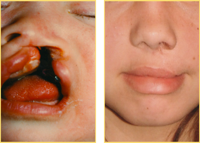 Cleft Lip Repair Cleft Lip Pediatric