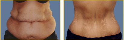Post-Bariatric Surgery