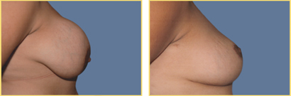 Breast Explanation Surgery