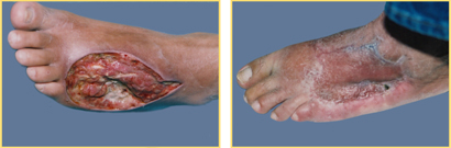 Foot Reconstruction