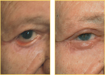 Head and Neck Cancer Reconstructive Surgery