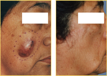 Head and Neck Cancer Reconstructive Surgery