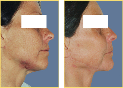 Head and Neck Cancer Reconstructive Surgery