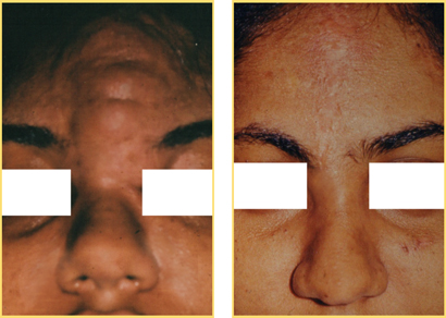 Head and Neck Cancer Reconstructive Surgery