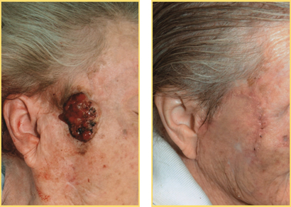 Head and Neck Cancer Reconstructive Surgery