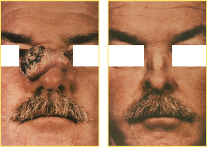 Head and Neck Cancer Reconstructive Surgery