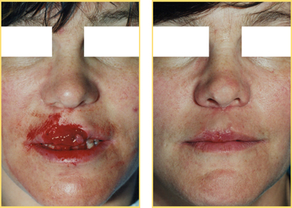 Head and Neck Cancer Reconstructive Surgery
