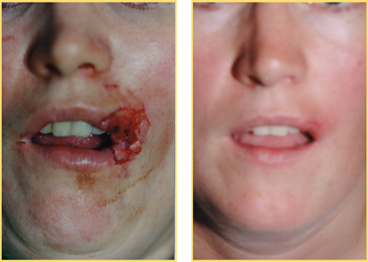 Head and Neck Cancer Reconstructive Surgery