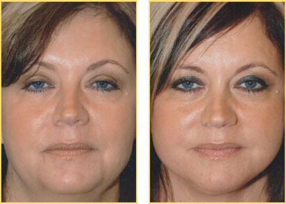 Laser Liposuction