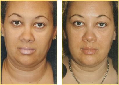 Laser Liposuction