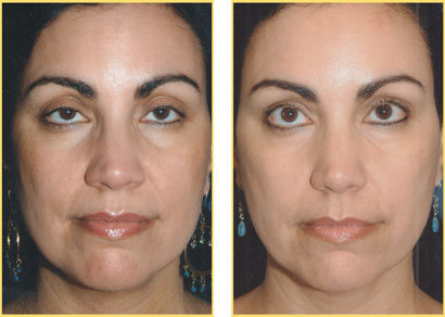 Laser Liposuction