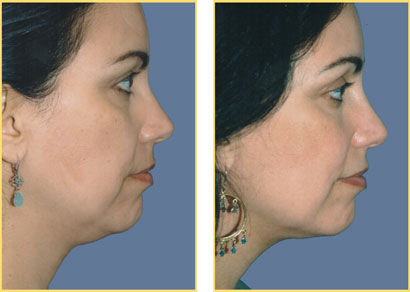 Laser Liposuction