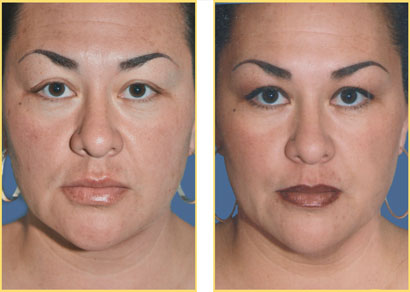 Laser Liposuction