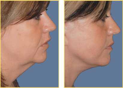 Laser Liposuction