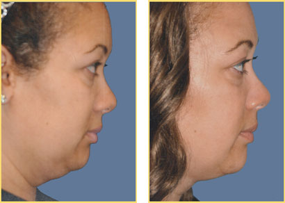 Laser Liposuction