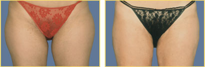 Patient Liposuction Photos