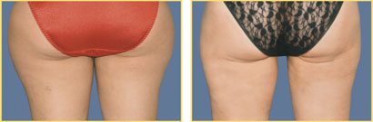 Patient Liposuction Photos