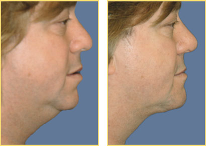 Laser Liposuction