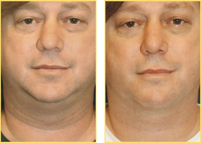 Laser Liposuction