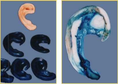 Microtia Reconstruction Surgery