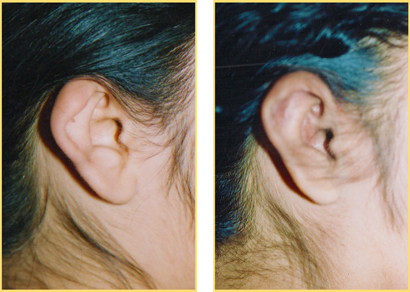 Microtia Reconstruction Surgery