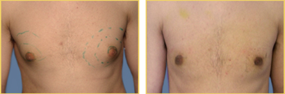 Gynecomastia