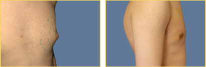 Gynecomastia