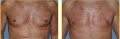 Gynecomastia