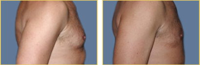 Gynecomastia
