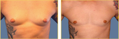 Gynecomastia before and after Gynecomastia before and after