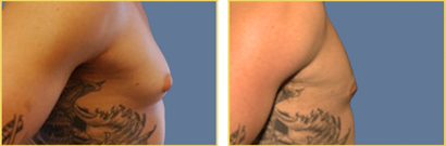 Gynecomastia before and after Gynecomastia before and after
