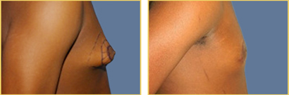 Gynecomastia