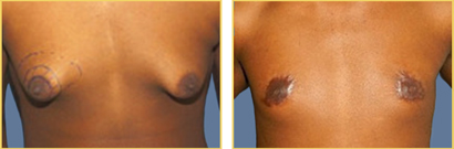 Gynecomastia