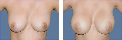 Breast Augmentation
