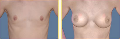 Breast Augmentation