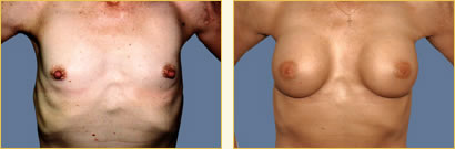 Breast Augmentation