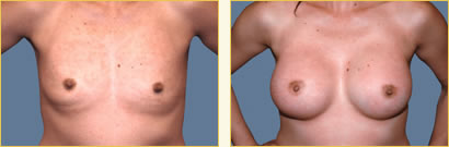 Breast Augmentation