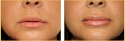 Lip Augmentation