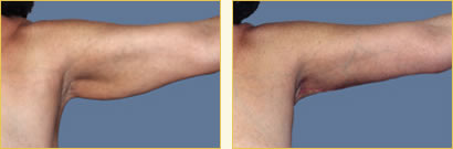 Brachioplasty