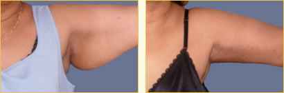 Brachioplasty