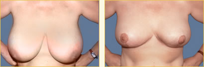 Breast Reduction