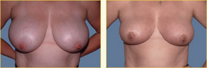 Breast Reduction