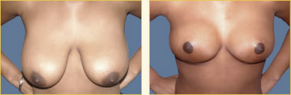 Breast Reduction