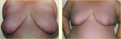 Breast Reduction
