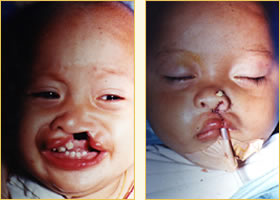 Pediatric Surgery