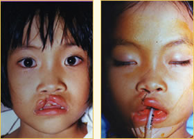 Cleft Lip Pediatric