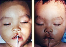 Cleft Lip Pediatric