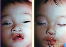 Cleft Lip Pediatric